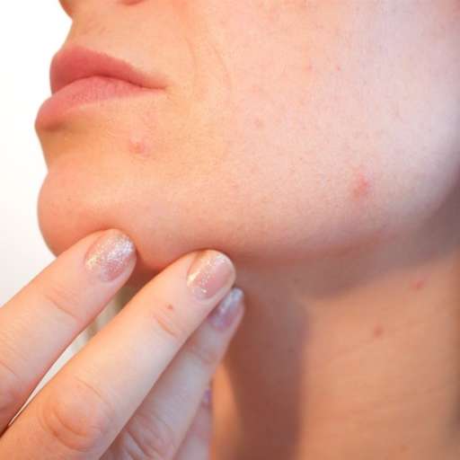 Consejos para hacer frente al acné veraniego